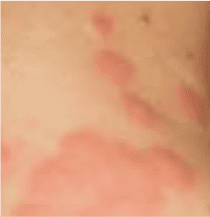 bedbugeffect What do bed bug bites look like